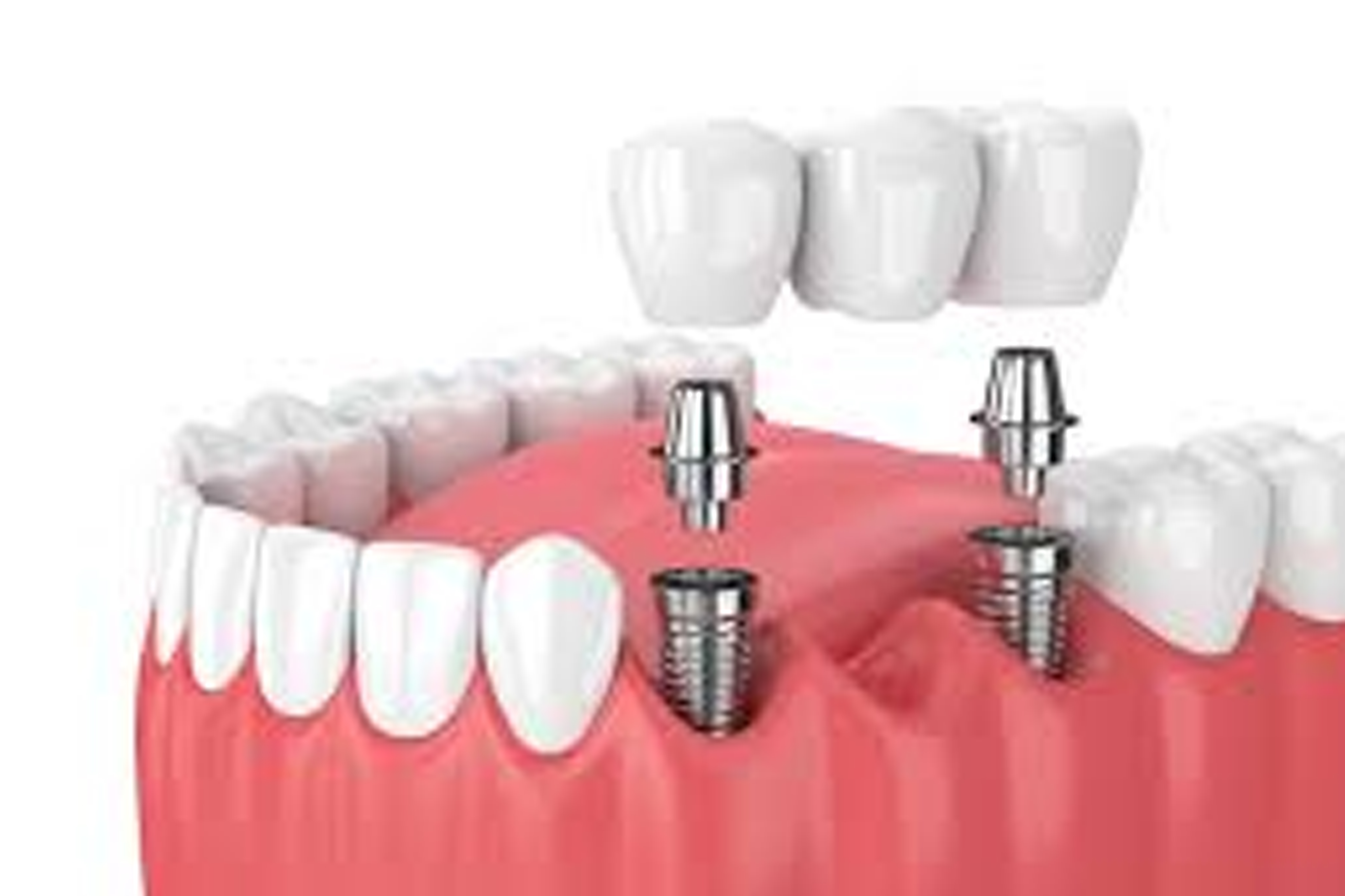 Implant Dentistry